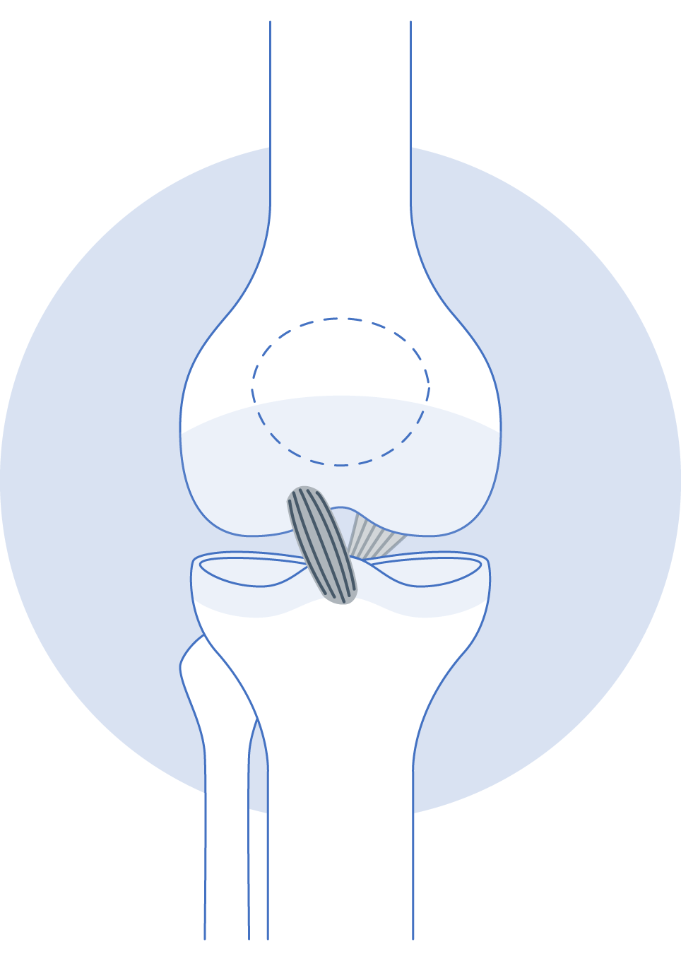 Knee ACL injury