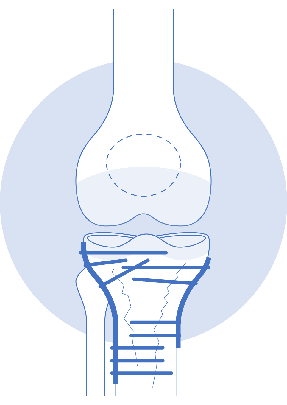 Knee fracture