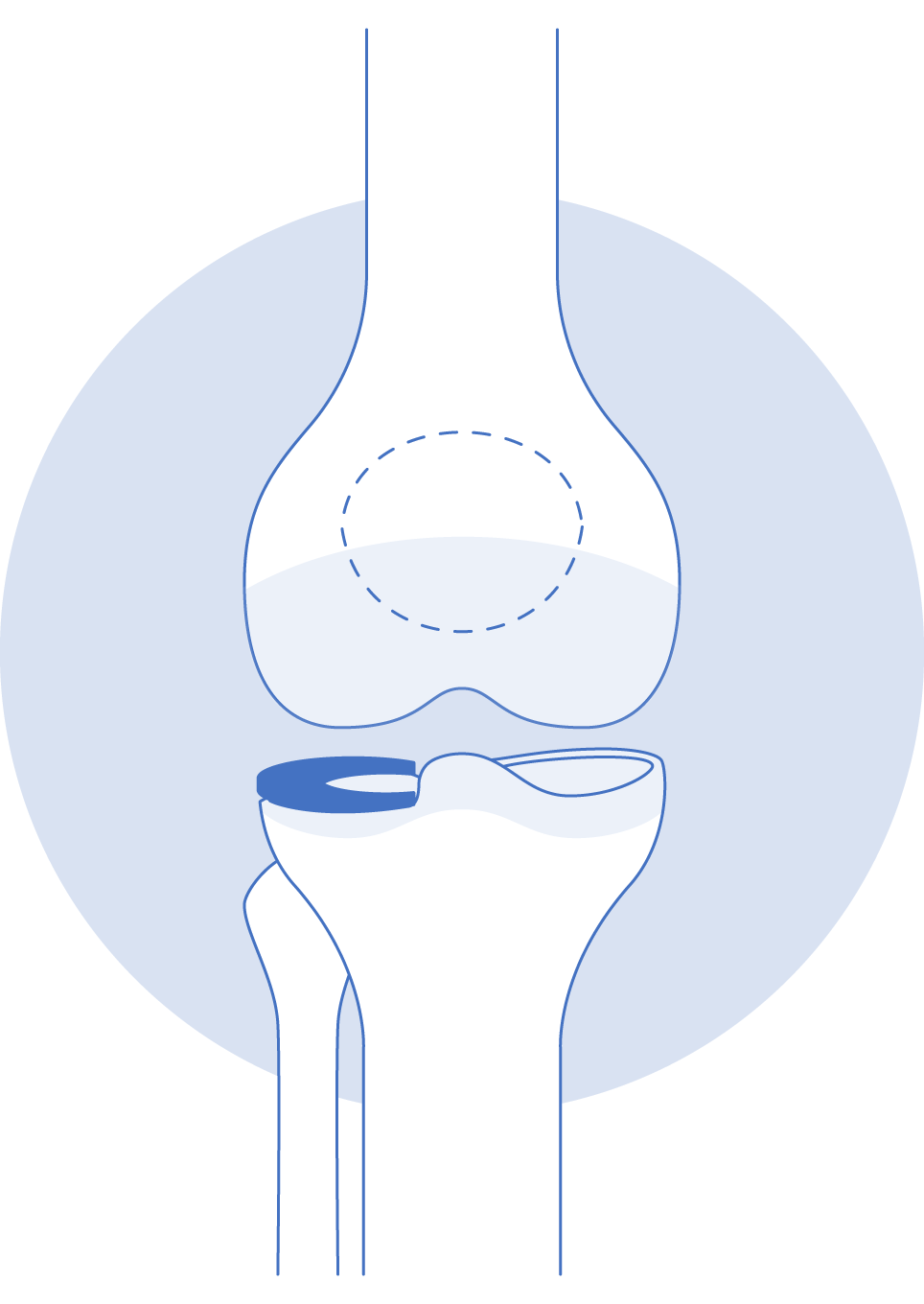 Knee meniscus injury